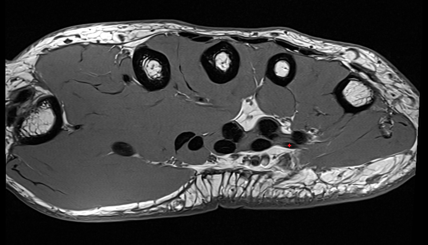 Fourth flexor digitorum superficialis tendon (little)  axial cross sectional anatomy 3T MRI AI enhanced radiology image-img-00000-00000