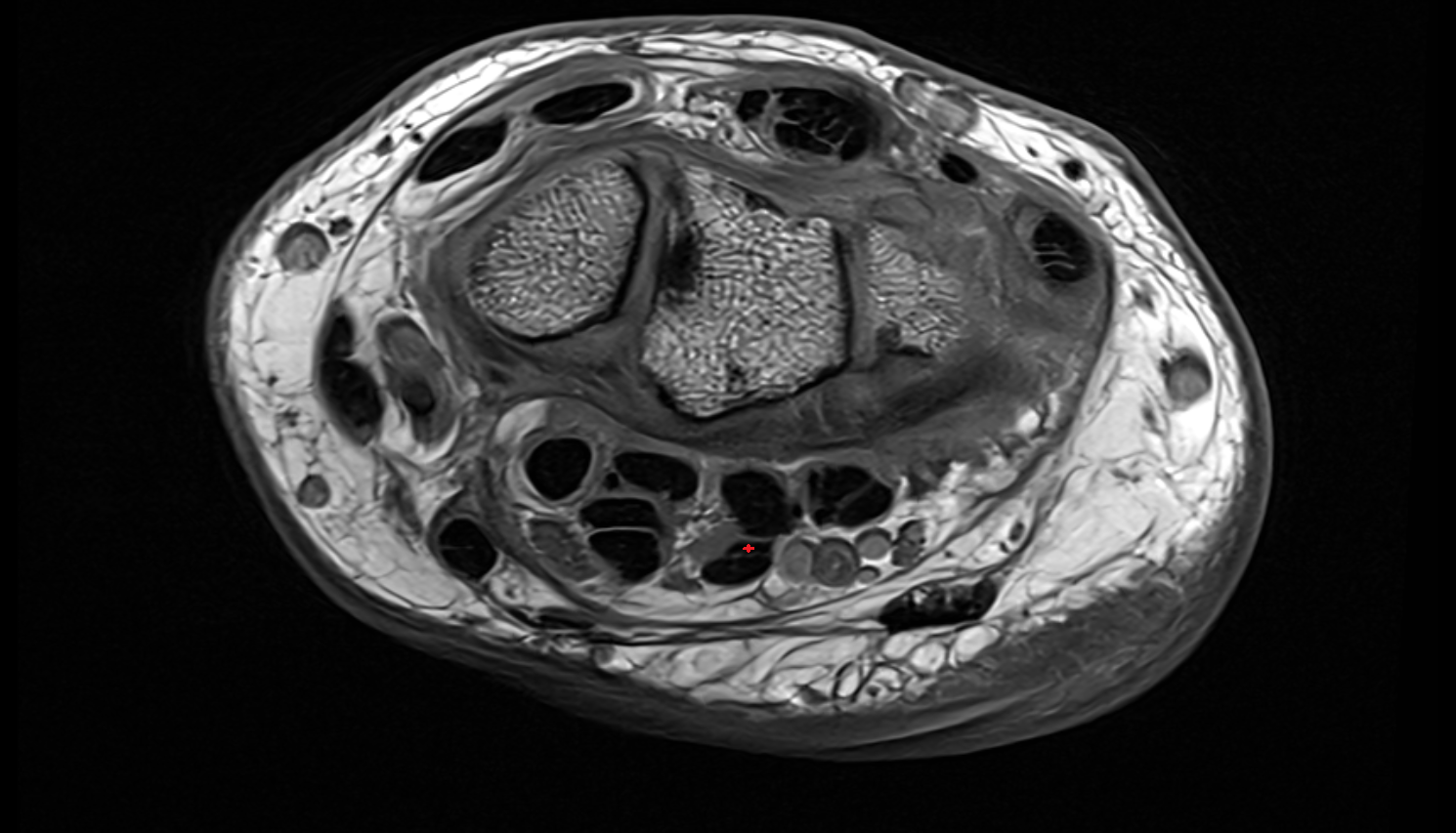Fourth flexor digitorum superficialis tendon (little)  axial cross sectional anatomy 3T MRI AI enhanced radiology image-img-00000-00000_00001