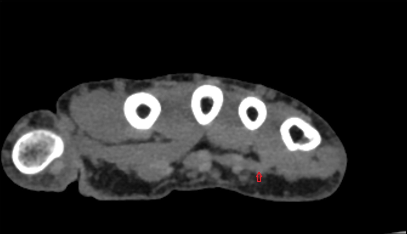 Fourth flexor digitorum superficialis tendon (little) ct axial