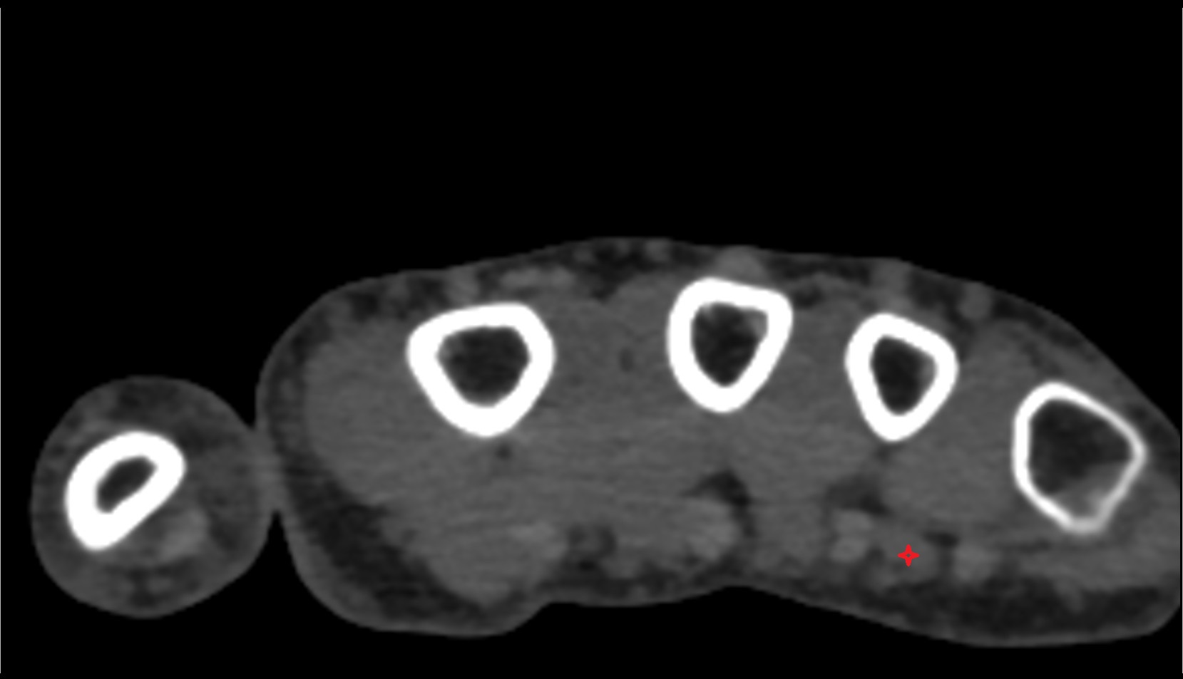 Fourth lumbrical muscle ct axial image hand