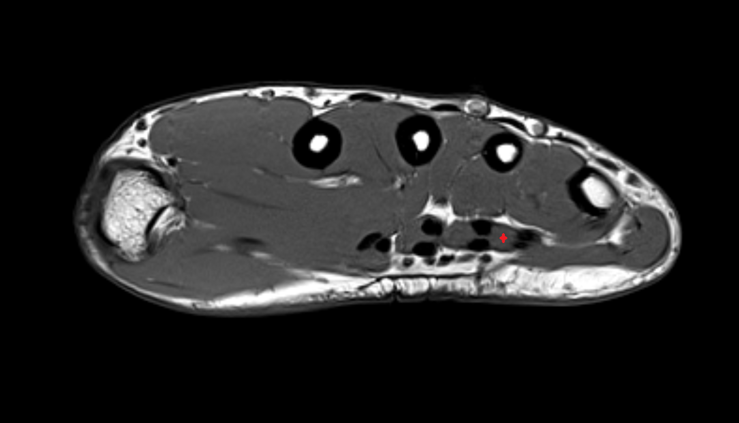 Fourth lumbrical  muscle of hand of hand axial cross sectional anatomy 3T MRI AI enhanced radiology image-img-00000-00000