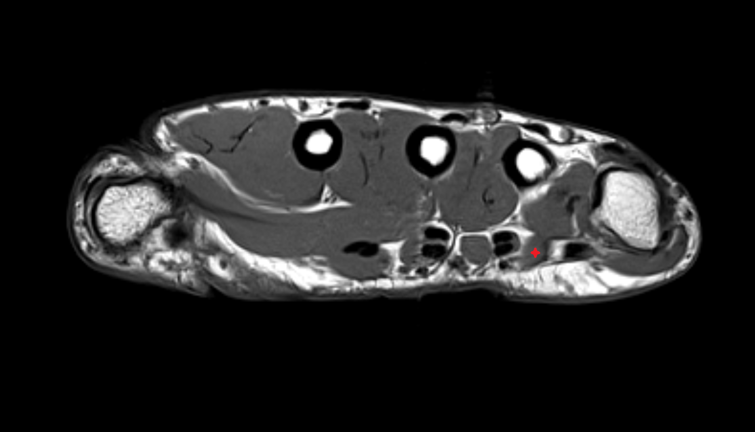 Fourth lumbrical  muscle of hand of hand axial cross sectional anatomy 3T MRI AI enhanced radiology image-img-00000-00000_00001
