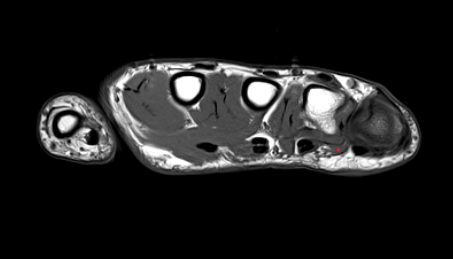 Fourth lumbrical  muscle of hand of hand axial cross sectional anatomy 3T MRI AI enhanced radiology image-img-00000-00000_00002