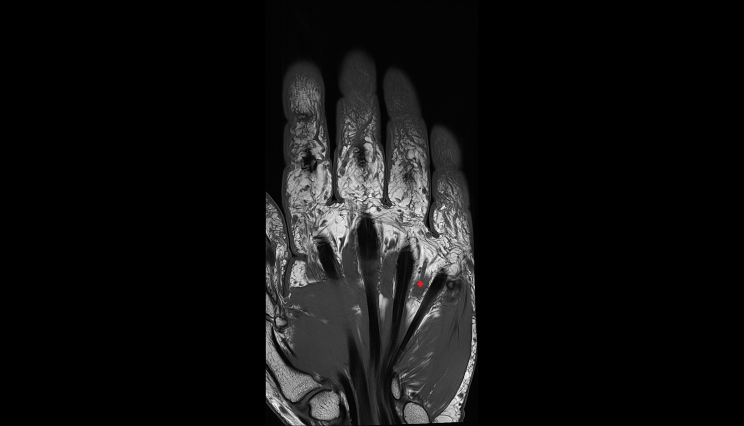 Fourth lumbrical  muscle of hand of hand coronal cross sectional anatomy 3T MRI AI enhanced radiology image-img-00000-00000