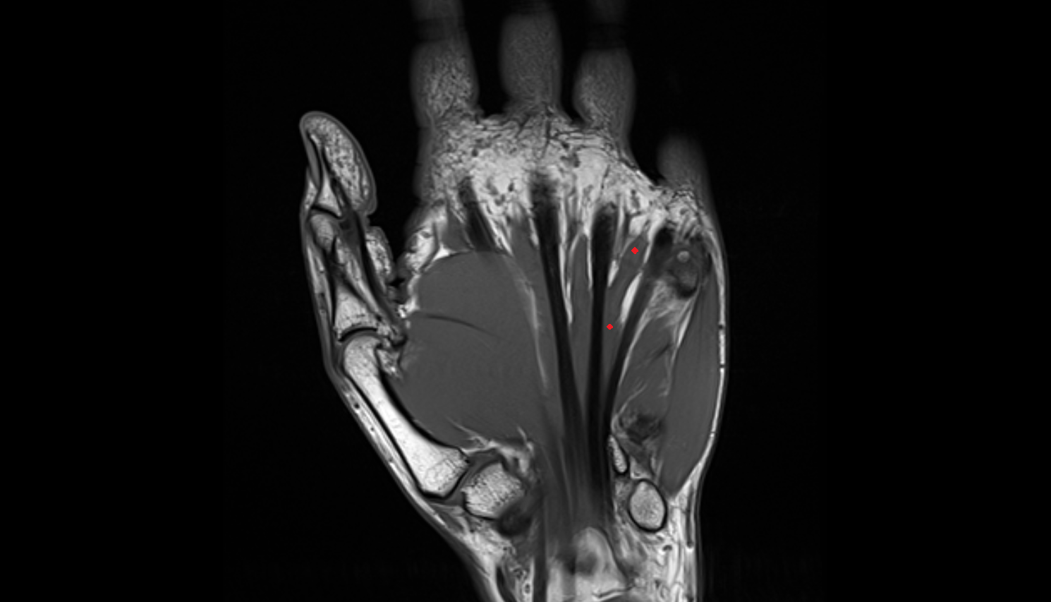 Fourth lumbrical  muscle of hand of hand coronal cross sectional anatomy 3T MRI AI enhanced radiology image-img-00000-00000_00001