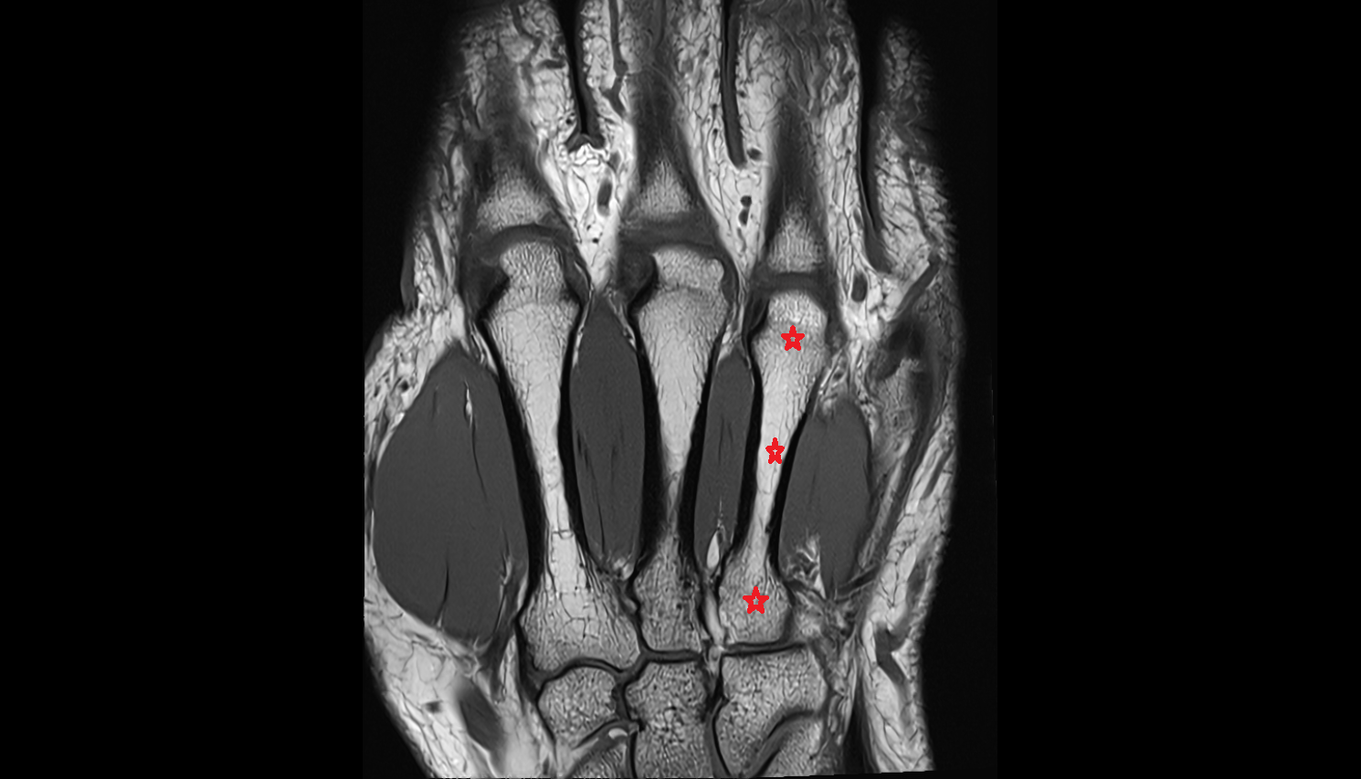 Fourth metacarpal bone (metacarpal IV)  coronal cross sectional anatomy 3T MRI AI enhanced radiology image-img-00000-00000