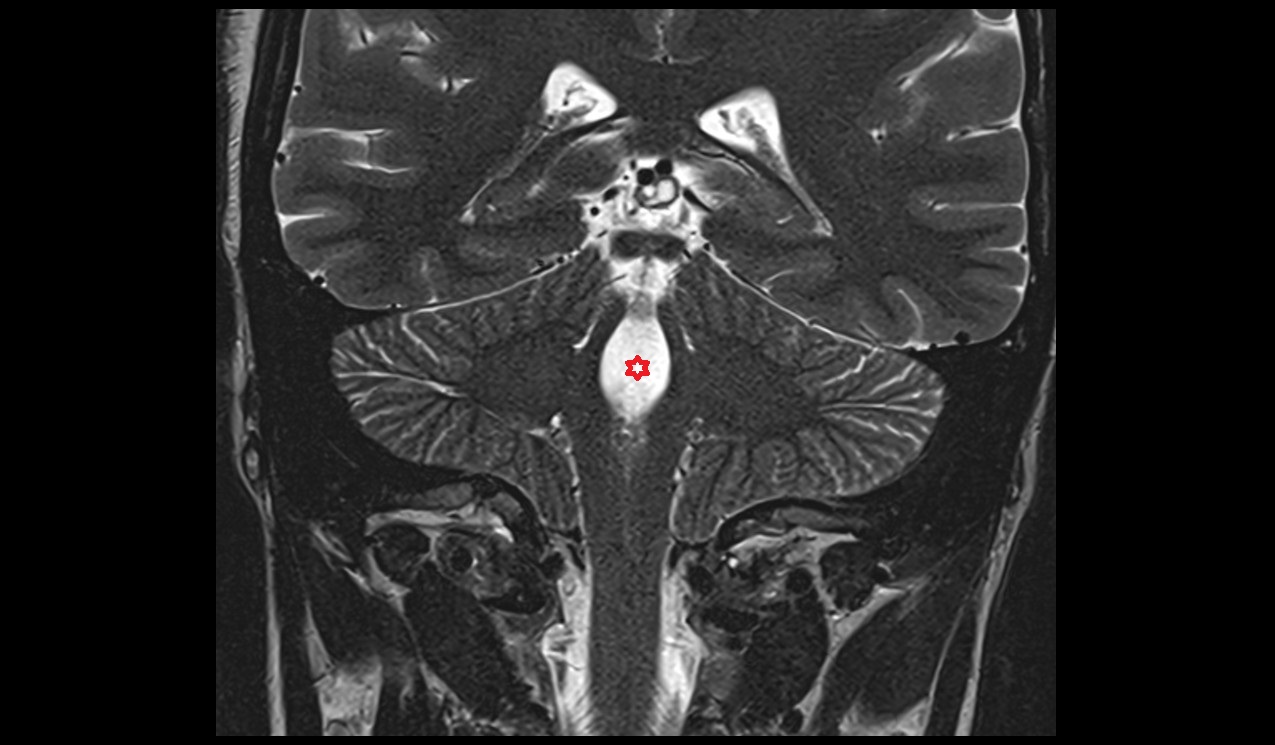 Fourth ventricle mri coronal 3t image