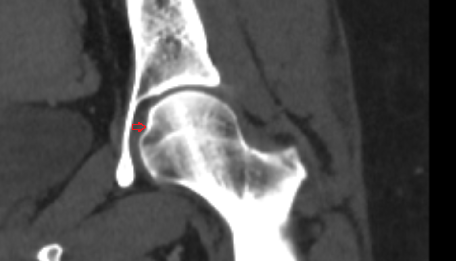 Fovea for ligament of head of femur ct  anatomy  Location and Imaging Appearance  -img-00000-00000