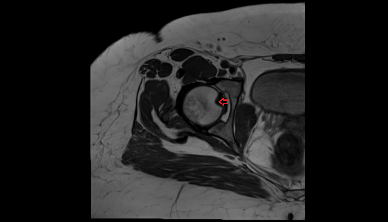 Fovea for ligament of head of femur mri  anatomy  Location and Imaging Appearance  -img-00000-00000
