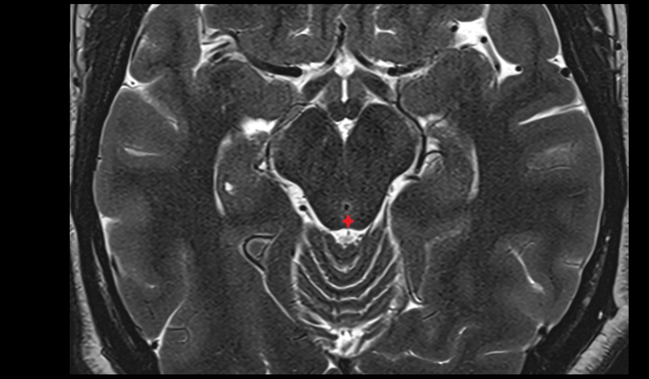 Frenulum veli mri 3t axial image