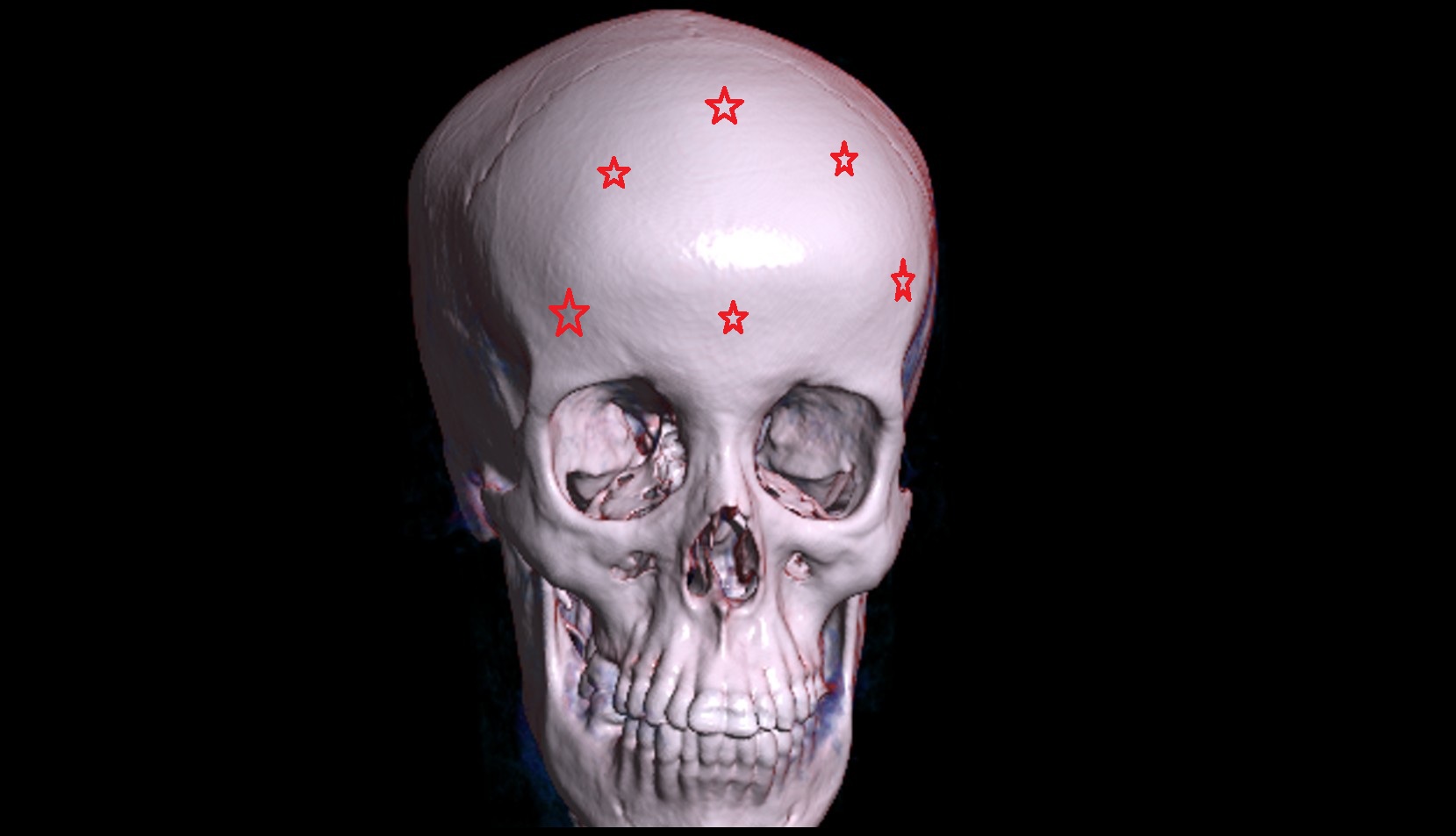 Frontal bone 3d