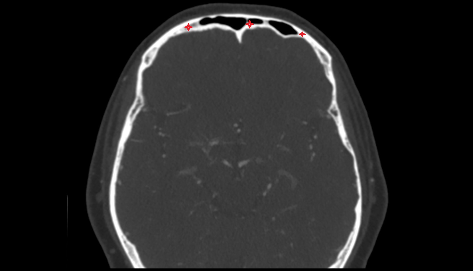 Frontal bone axial  ct image