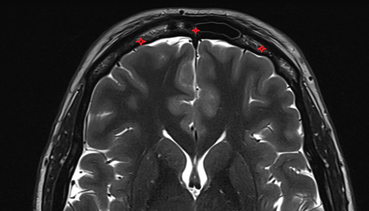 Frontal bone axial mri image-img-00000-00000