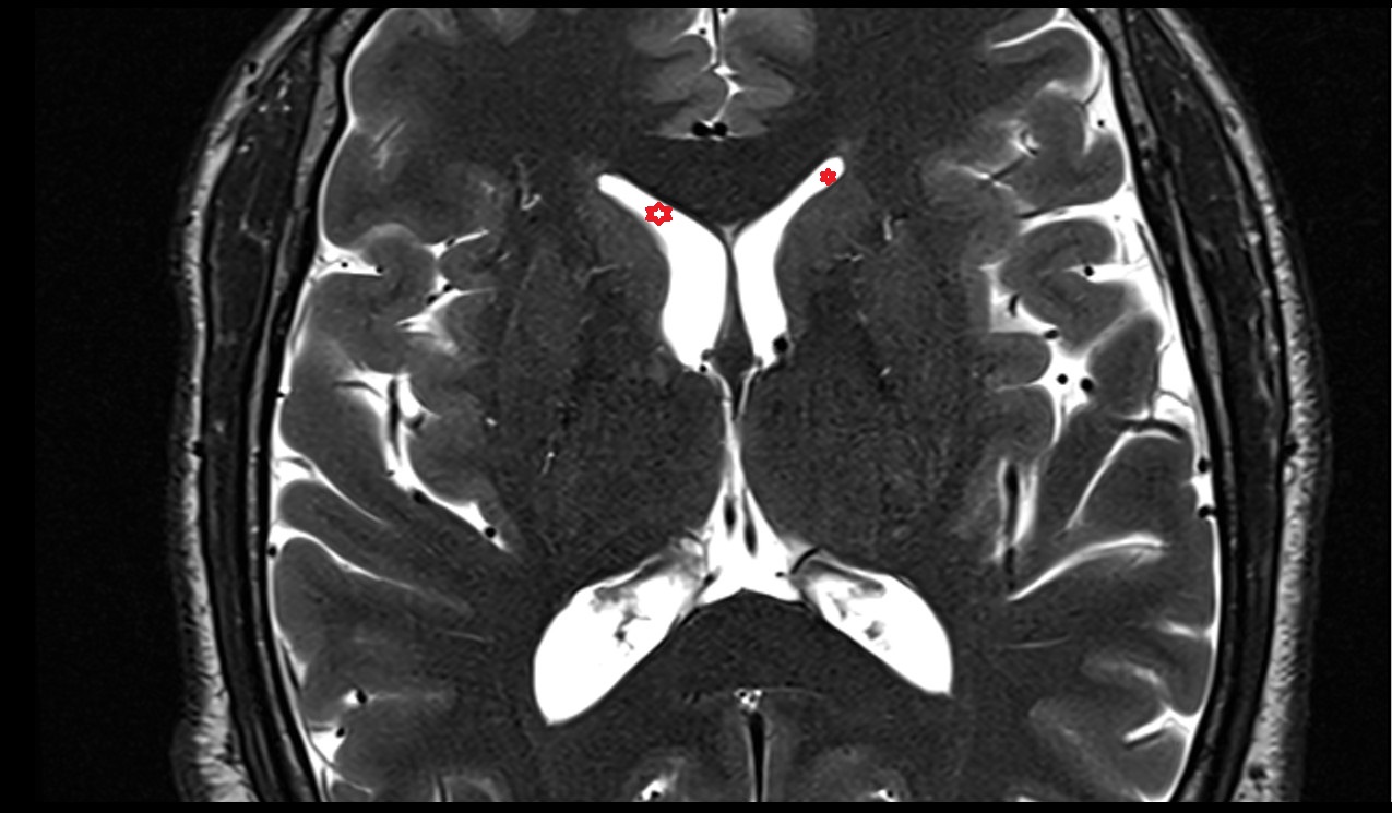 Frontal horn of lateral ventricle; Anterior horn of lateral ventricle mri 3t  axial image