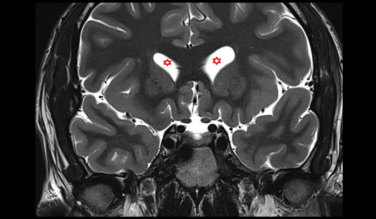 Frontal horn of lateral ventricle; Anterior horn of lateral ventricle mri 3t coronal image