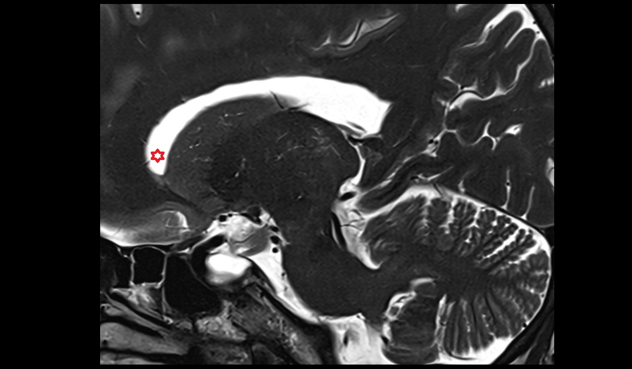 Frontal horn of lateral ventricle; Anterior horn of lateral ventricle mri 3t sagittal image