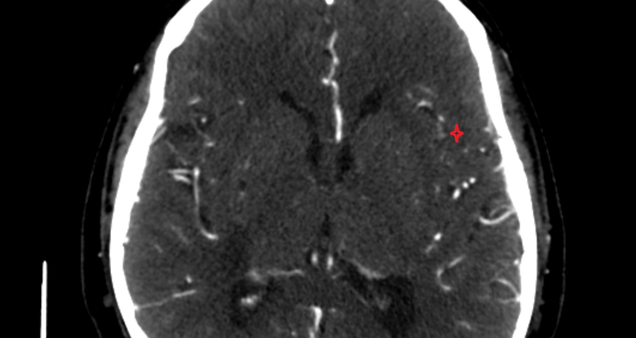 Frontal operculum  CT sagittal anatomy image -img-00001-00001