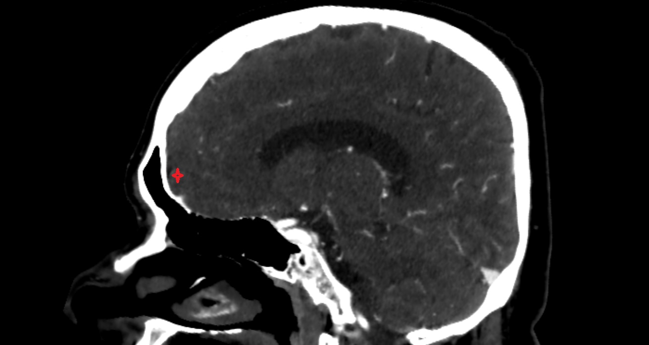 Frontal pole  CT sagittal anatomy image -img-00001-00001