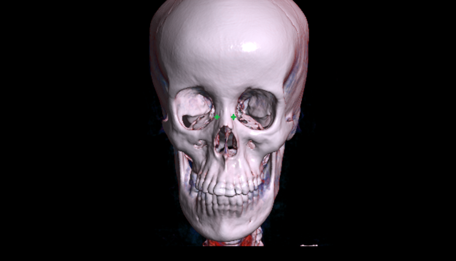 Frontal process of maxilla  CT 3d anatomy labelled image-img-00000-00000