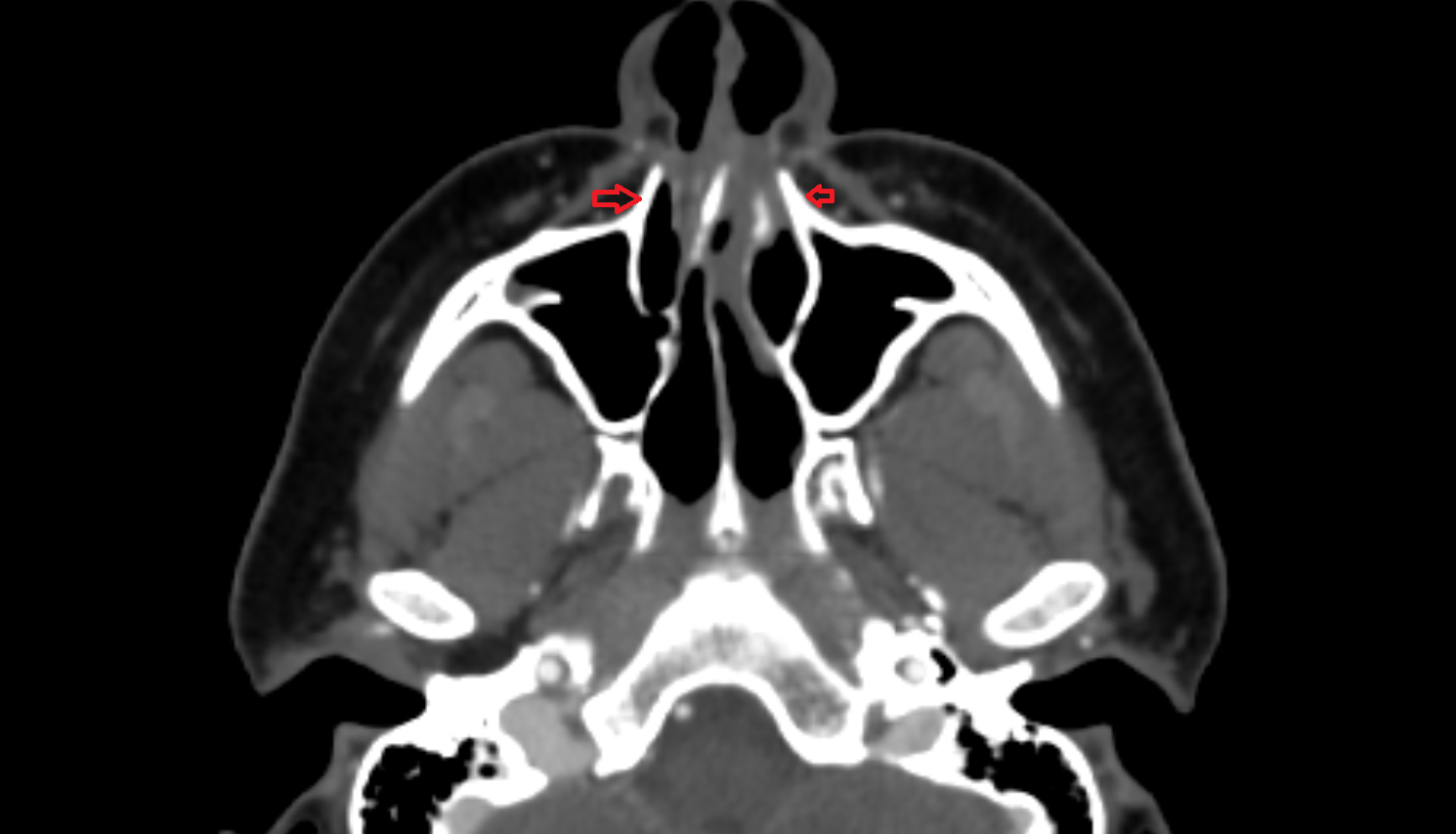 Frontal process of maxilla CT  anatomy labelled image-img-00000-00000_00001