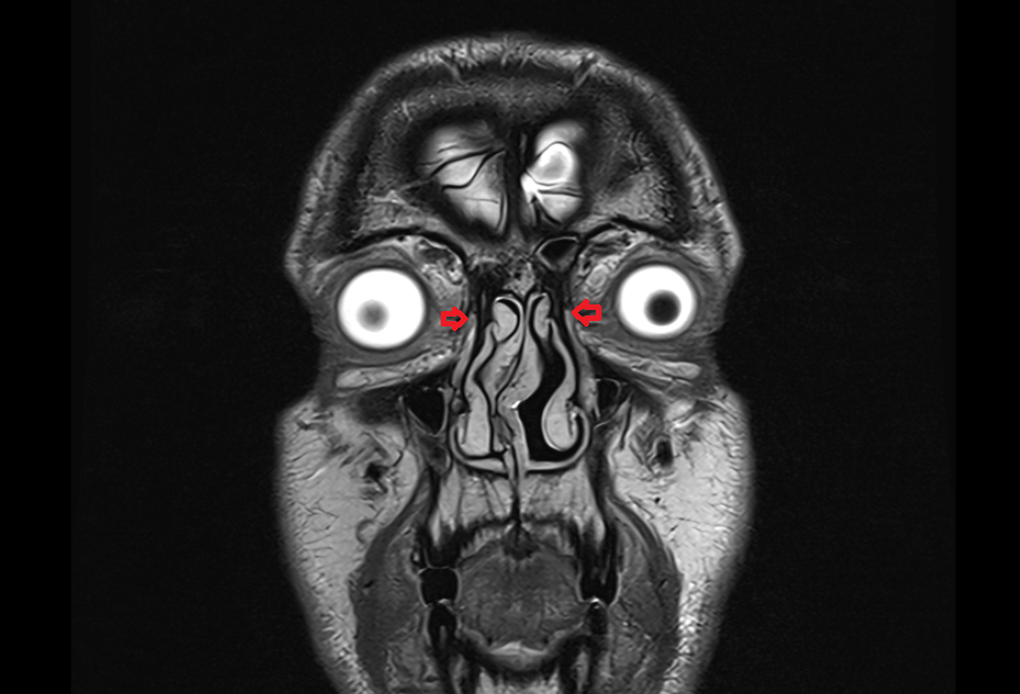 Frontal process of maxilla MRI  anatomy labelled image-img-00000-00000