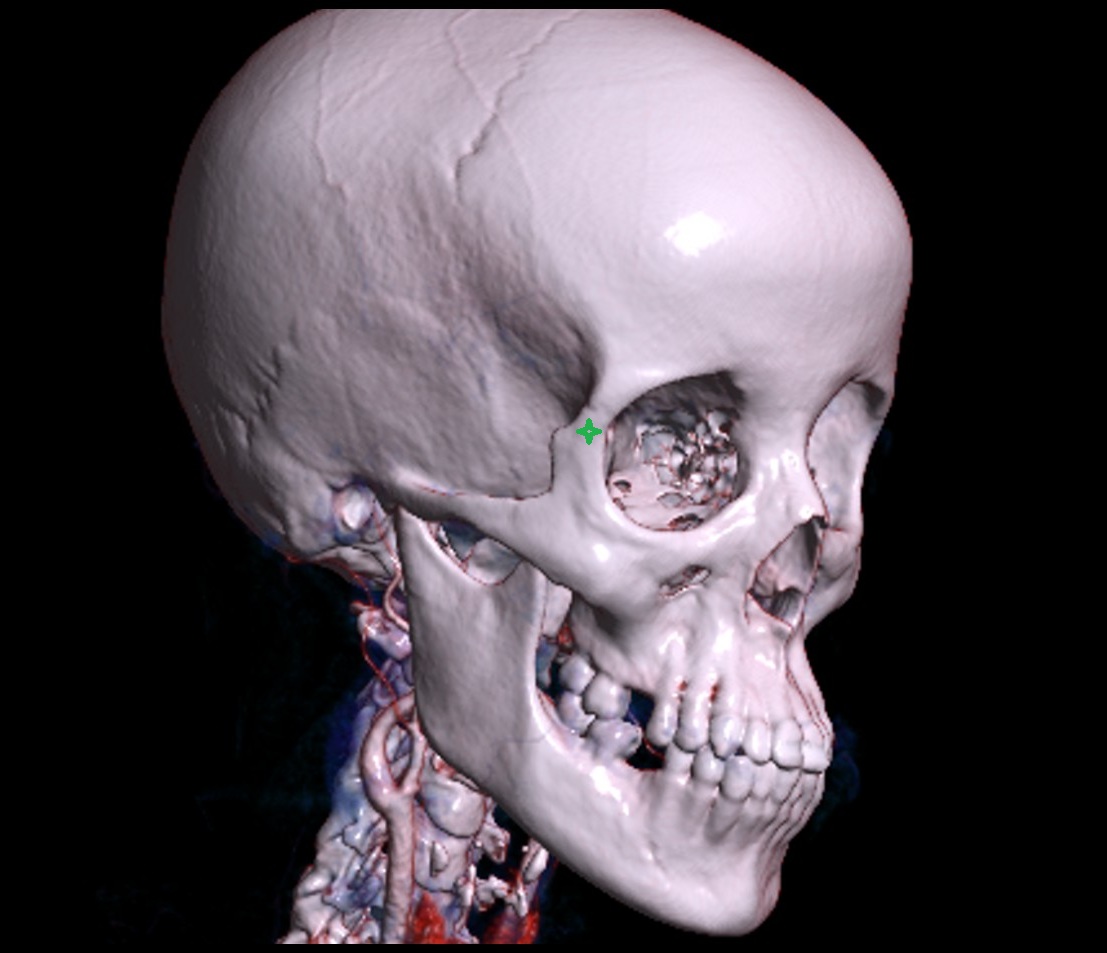 Frontal process of zygomatic bone 3d