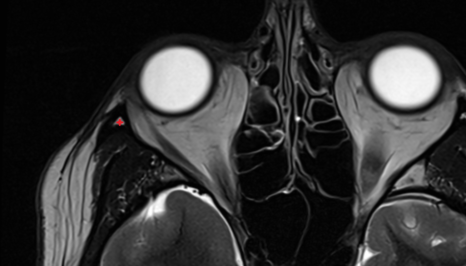Frontal process (zygomatic bone)  mri axial image -img-00000-00000