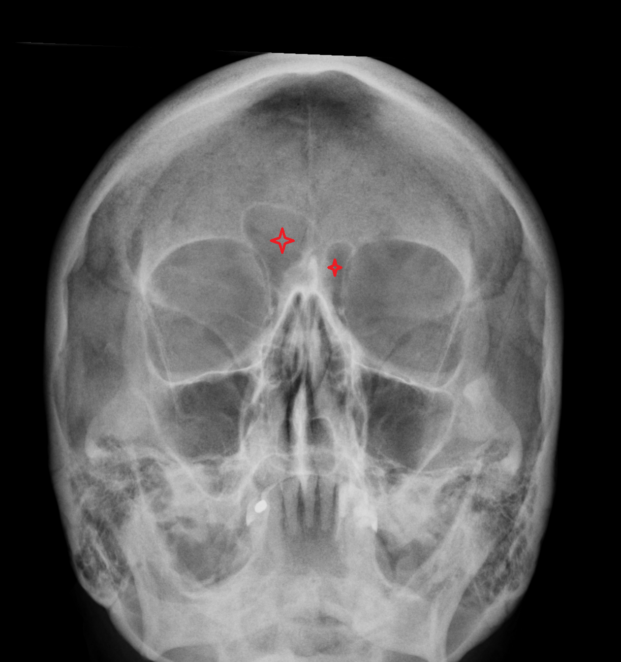 Frontal sinus