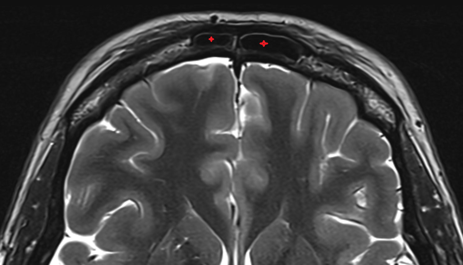 Frontal sinus axial mri image-img-00000-00000