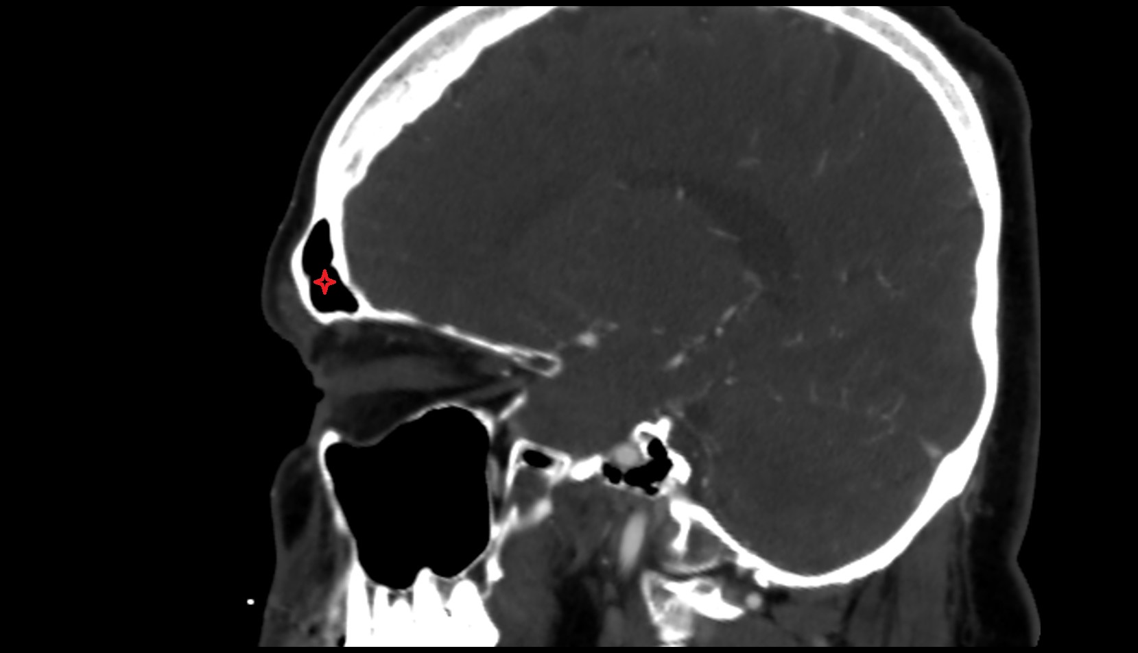 Frontal sinus ct sagittal image