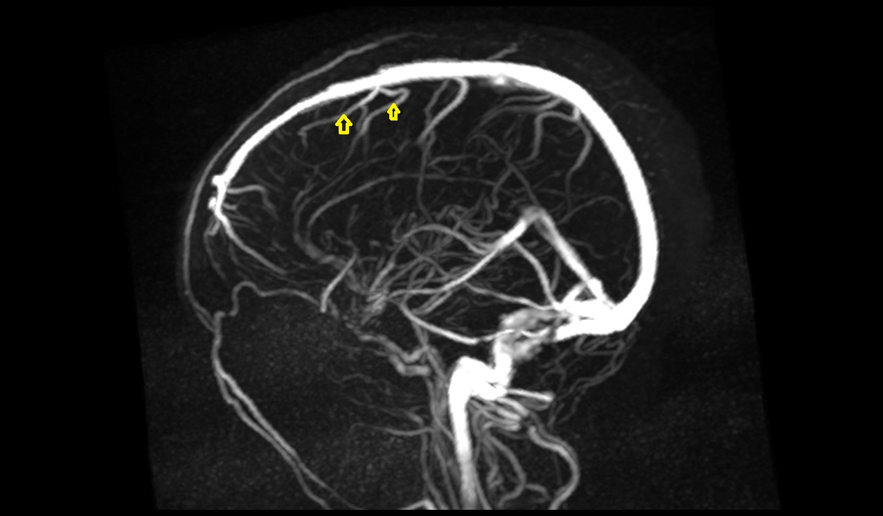 Frontal veins MRI 3T SAG mip image