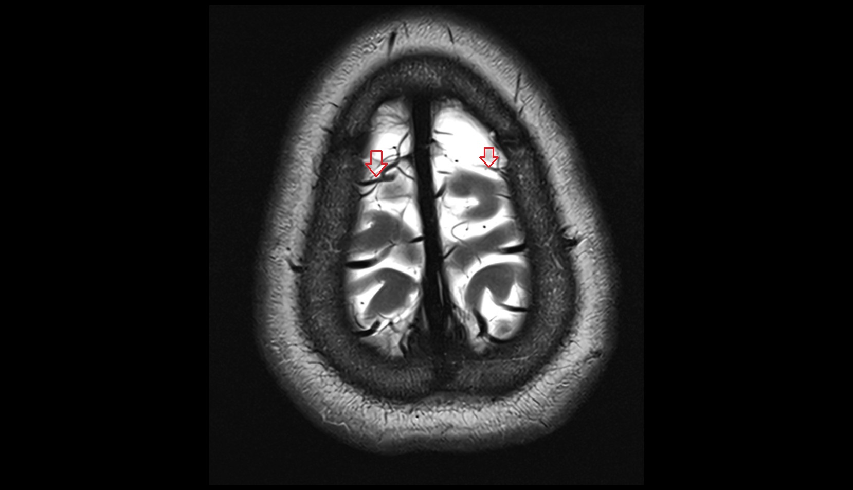 Frontal veins MRI 3T axial image