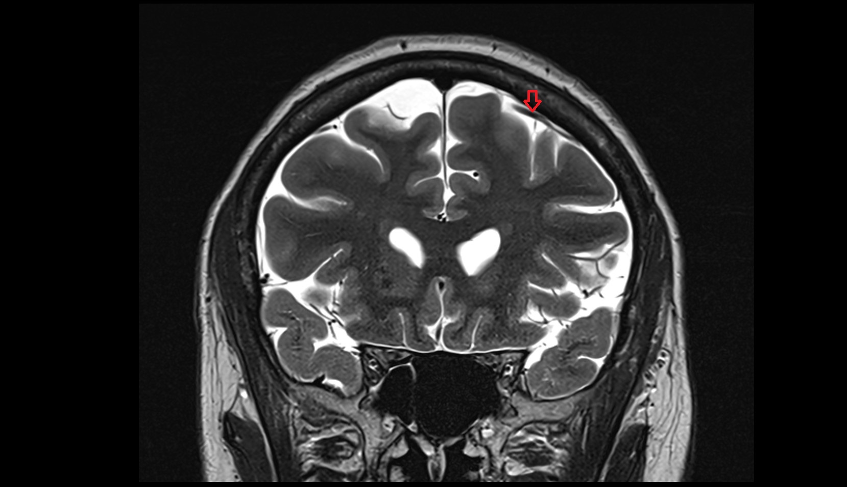 Frontal veins MRI 3T coronal image