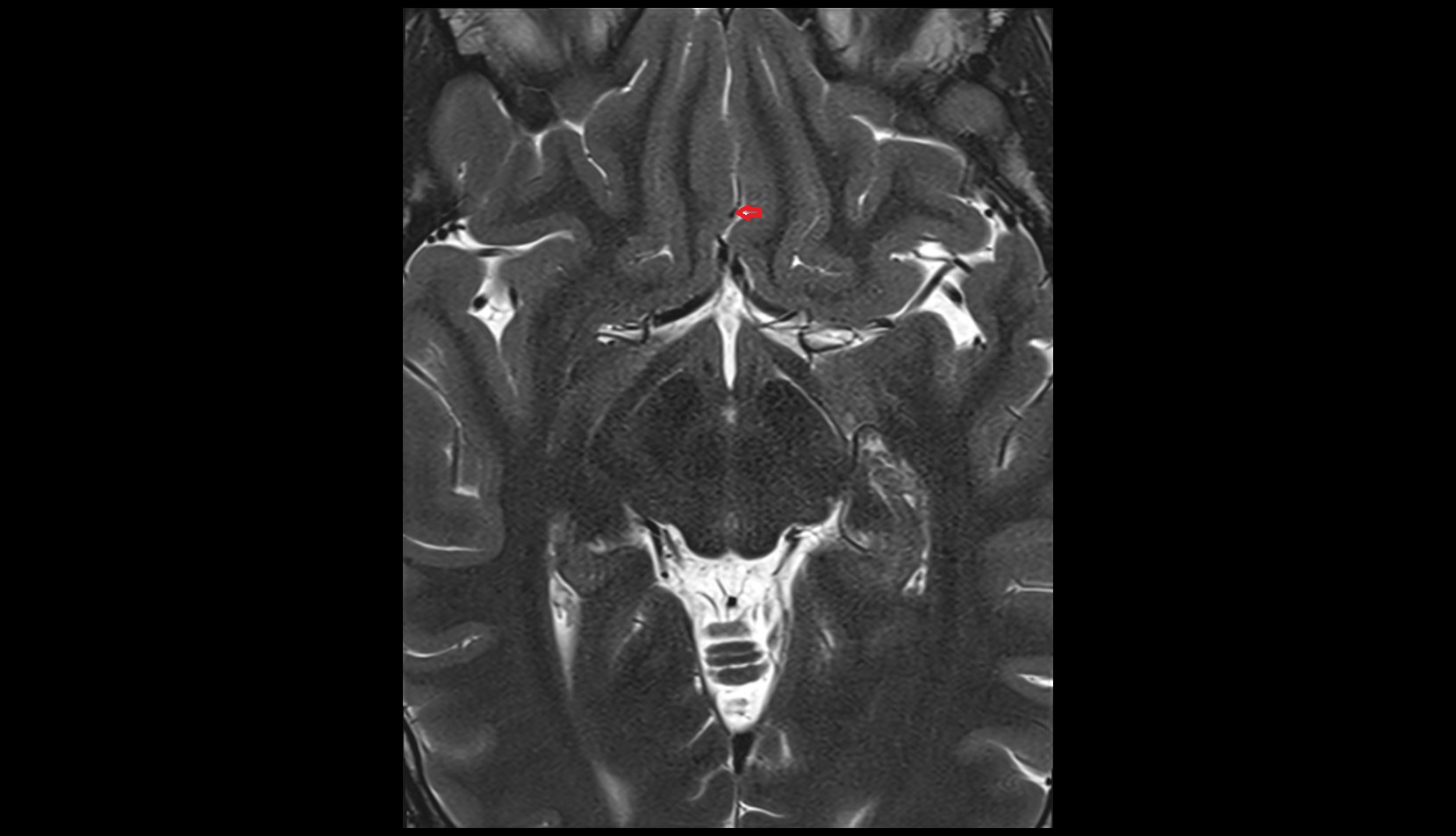 Frontopolar artery (FPA)