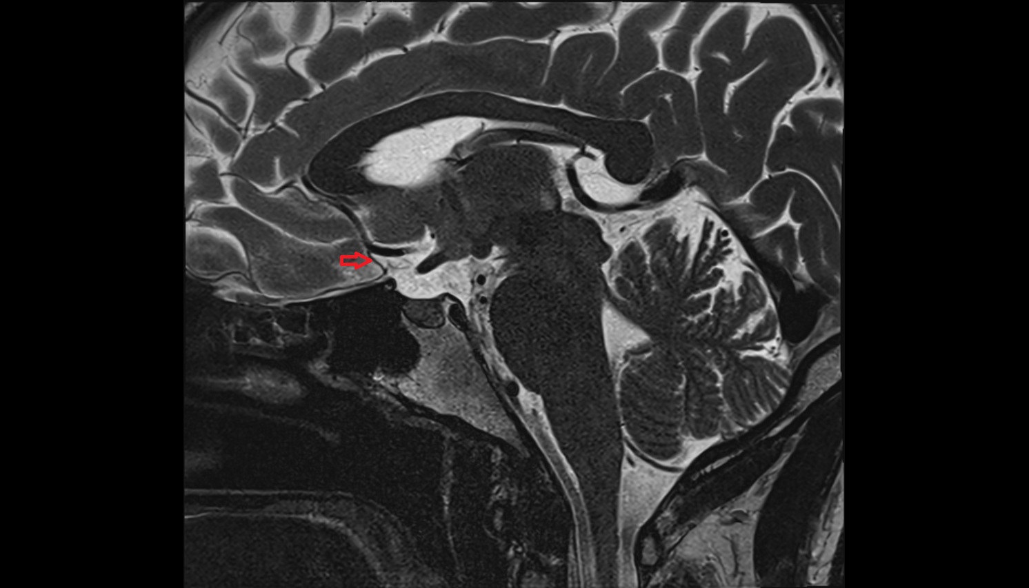 Frontopolar artery (FPA)  mri sagittal  image -img-00000-00000
