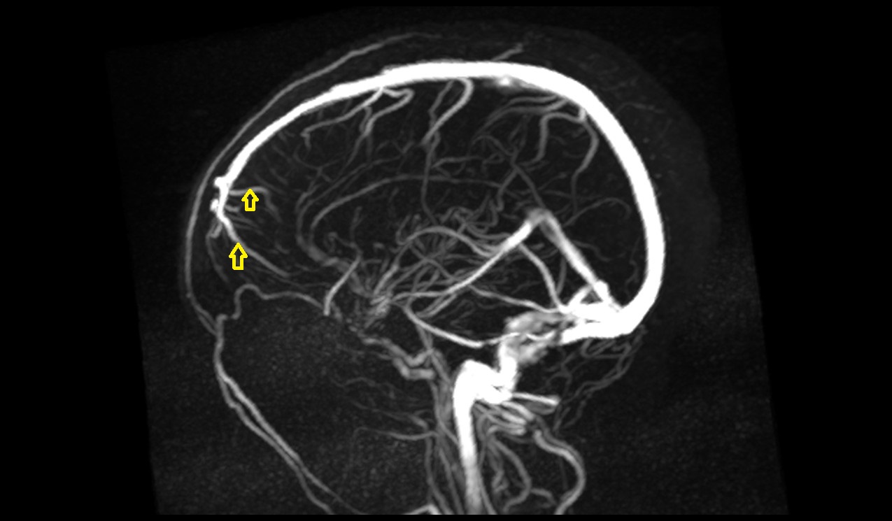 Frontopolar vein MRI 3T sag mip image