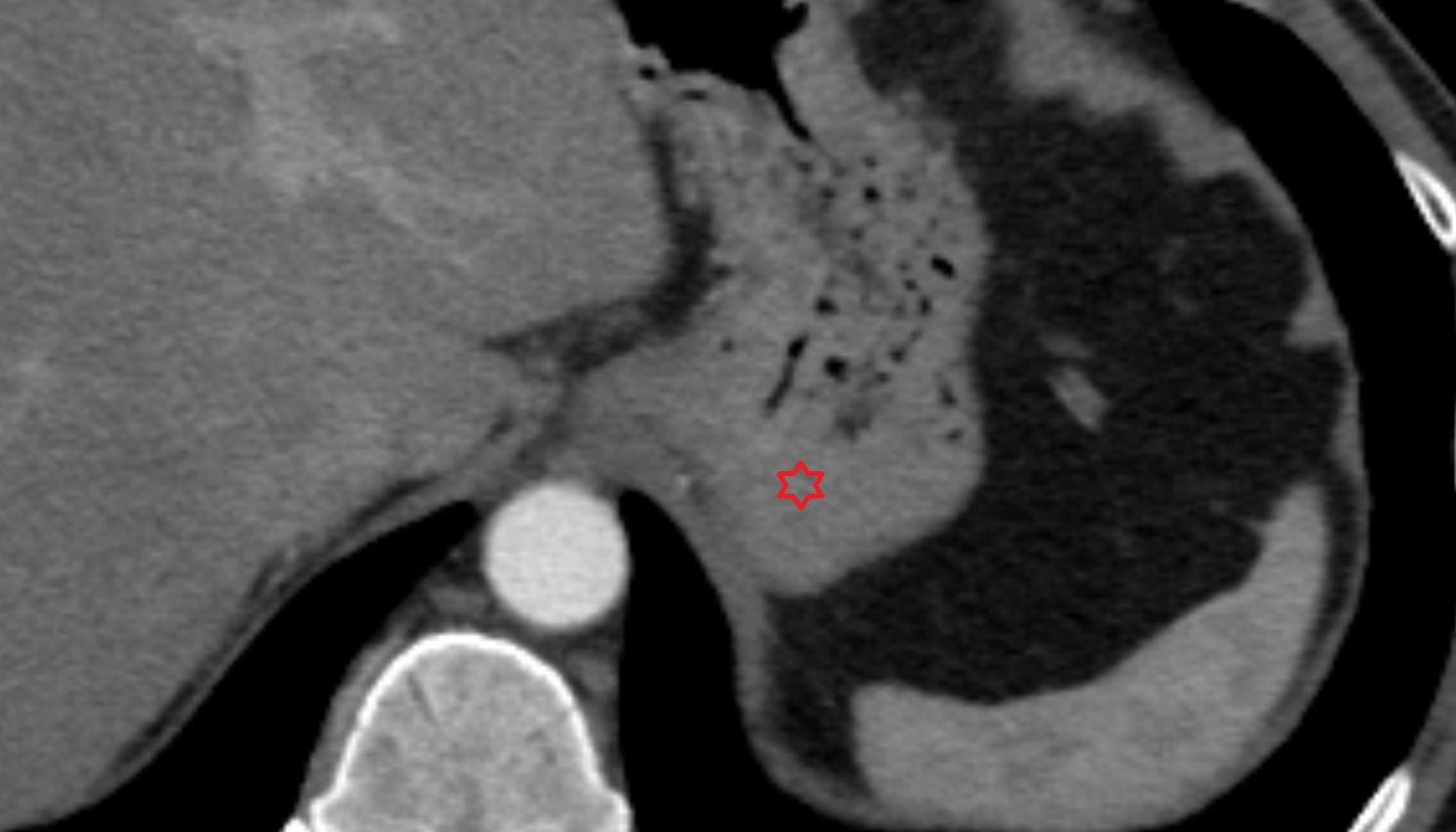 Fundus of stomach  anatomy CT axial  image -img-00000-00000
