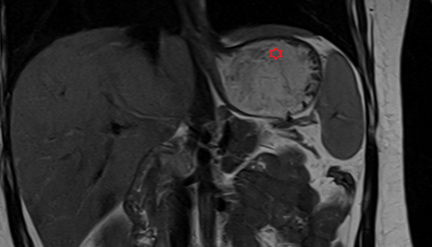 Fundus of stomach  anatomy MRI coronal  image -img-00000-00000