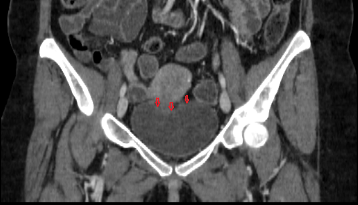 Fundus  of urinary bladder  ct  coronal  anatomy  image-img-00000-00000_00001