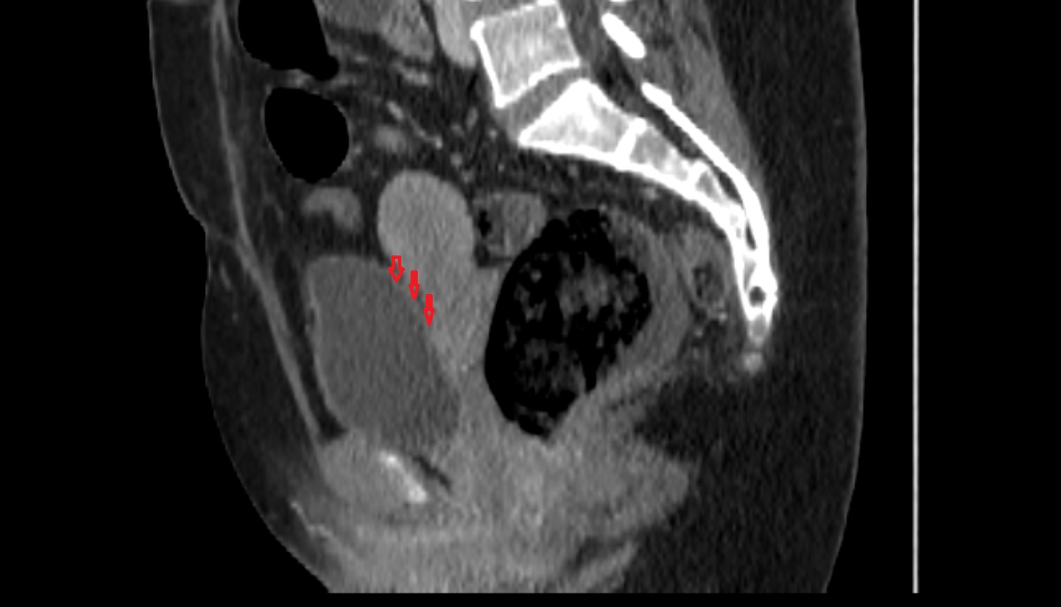 Fundus  of urinary bladder  ct  sagittal  anatomy  image-img-00000-00000