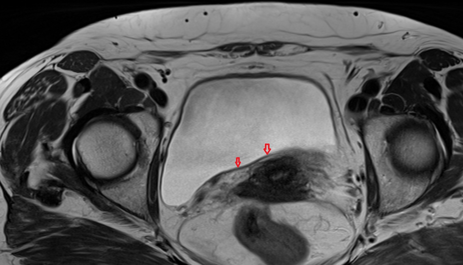 Fundus  of urinary bladder  mri  axial  anatomy  image-img-00000-00000