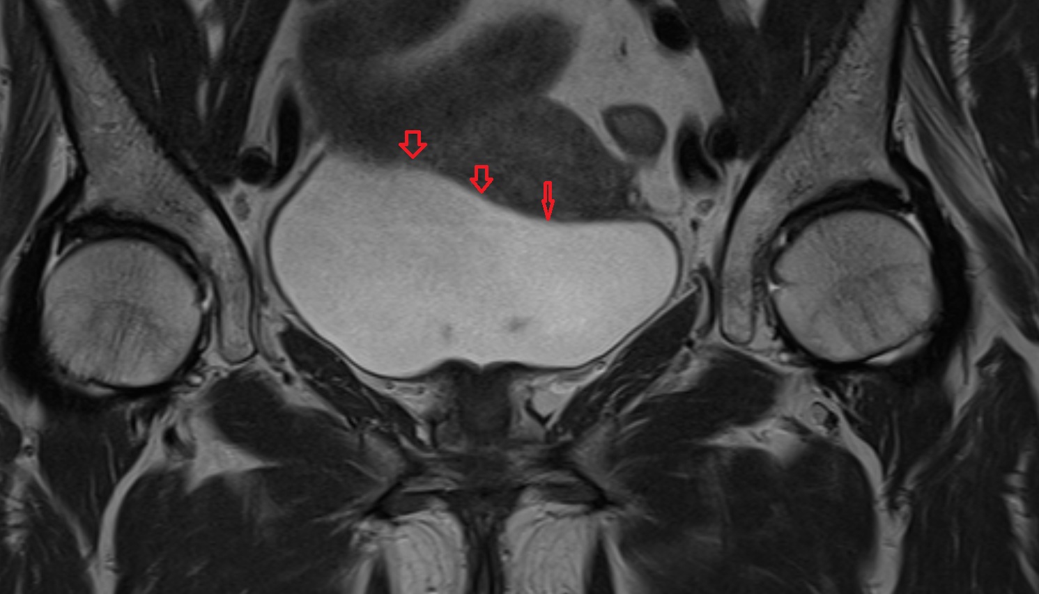 Fundus  of urinary bladder  mri coronal  anatomy  image-img-00000-00000