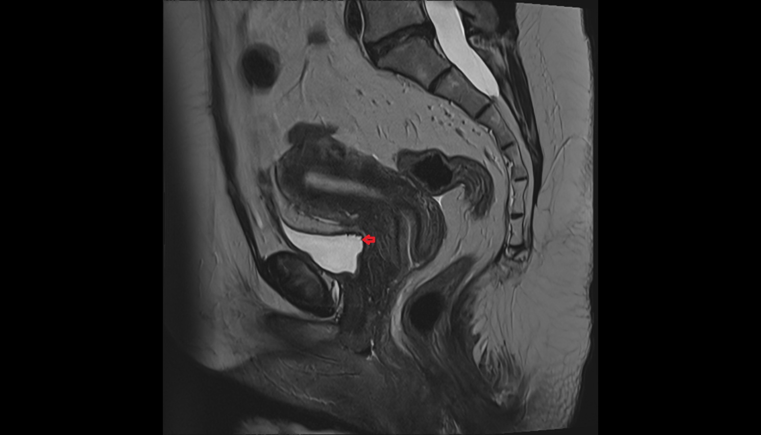 Fundus  of urinary bladder  mri   sagittal  anatomy  image-img-00000-00000