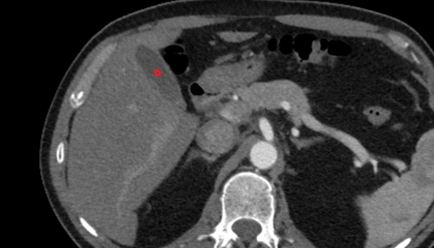 Gallbladder  anatomy CT axial  image -img-00000-00000