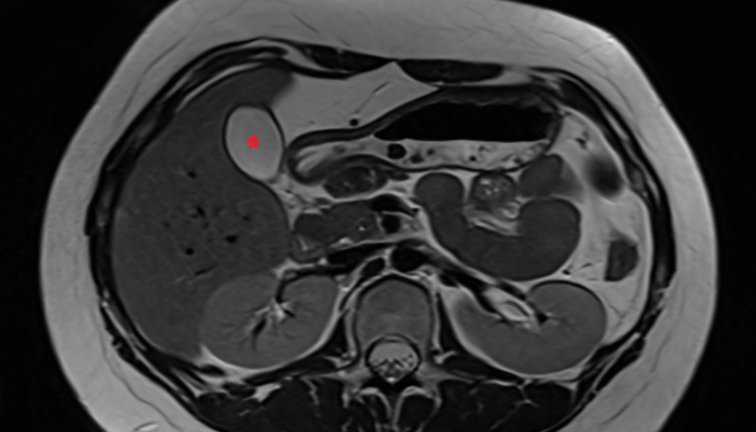 Gallbladder  anatomy MRI axial  image -img-00000-00000