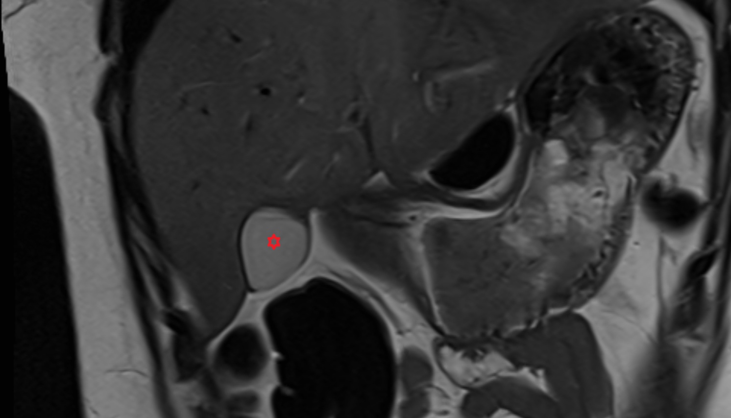 Gallbladder  anatomy MRI coronal  image -img-00000-00000