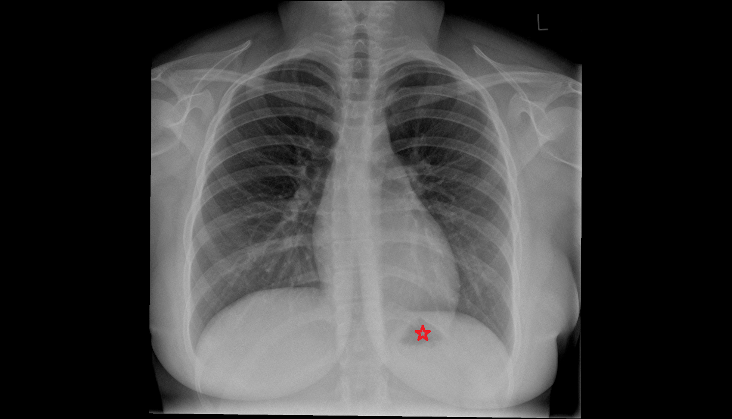 Gastric bubble  X ray Anatomy, Location and Imaging Appearance  -img-00000-00000