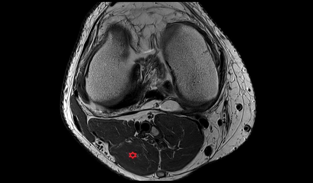 Gastrocnemius muscle (lateral head) anatomy image