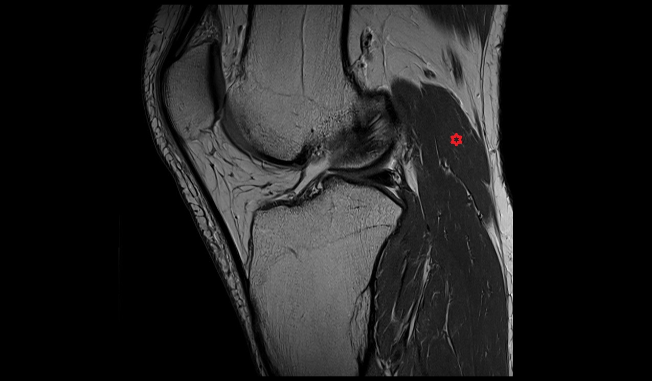 Gastrocnemius muscle (lateral head) anatomy image  MRI 3T