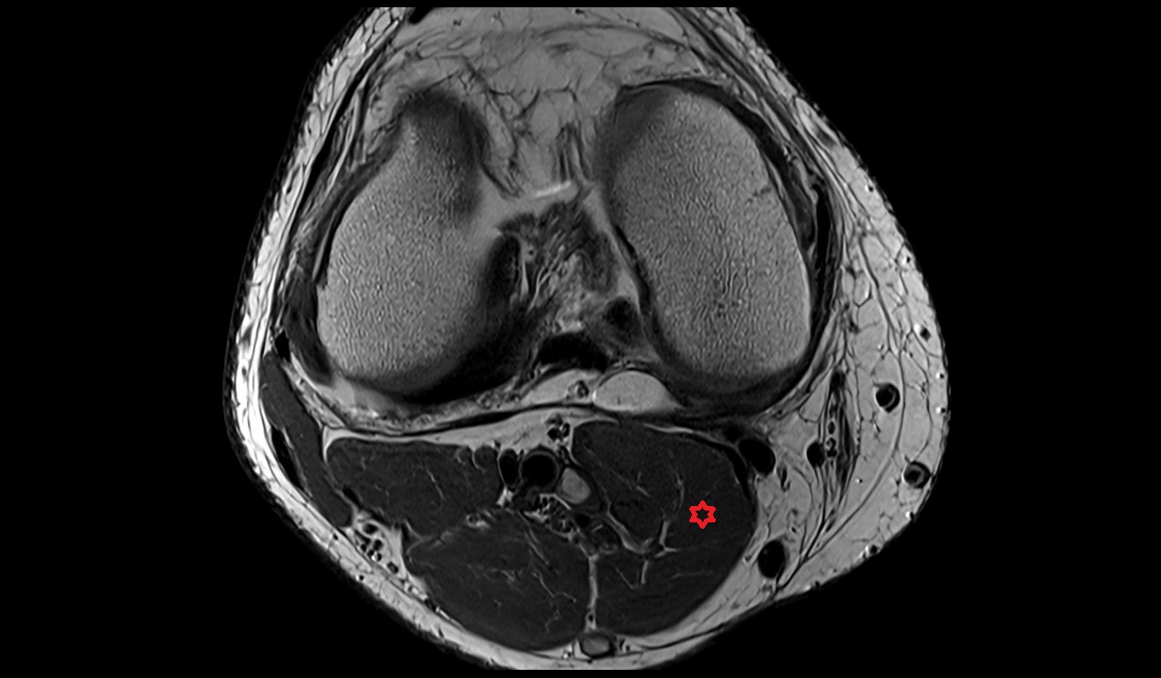 Gastrocnemius muscle (medial head ) anatomy image